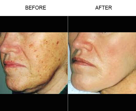 Laser Skin Resurfacing Treatment Results